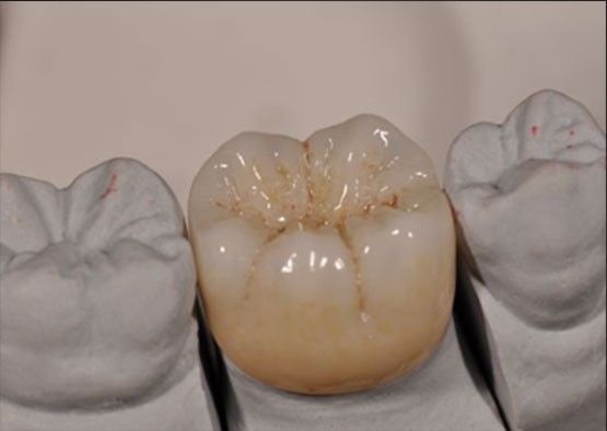 उच्च सौंदर्य Noritake Zirconia प्राकृतिक रंग पूर्ण Zirconia मुकुट के लिए स्थिर